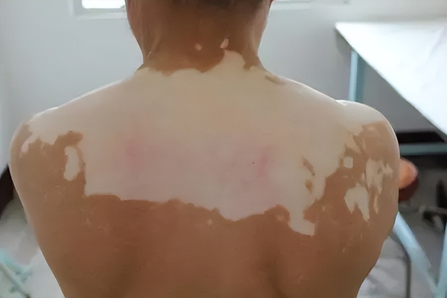 白癜风男孩患者真实记录,28岁小伙头部白癜风