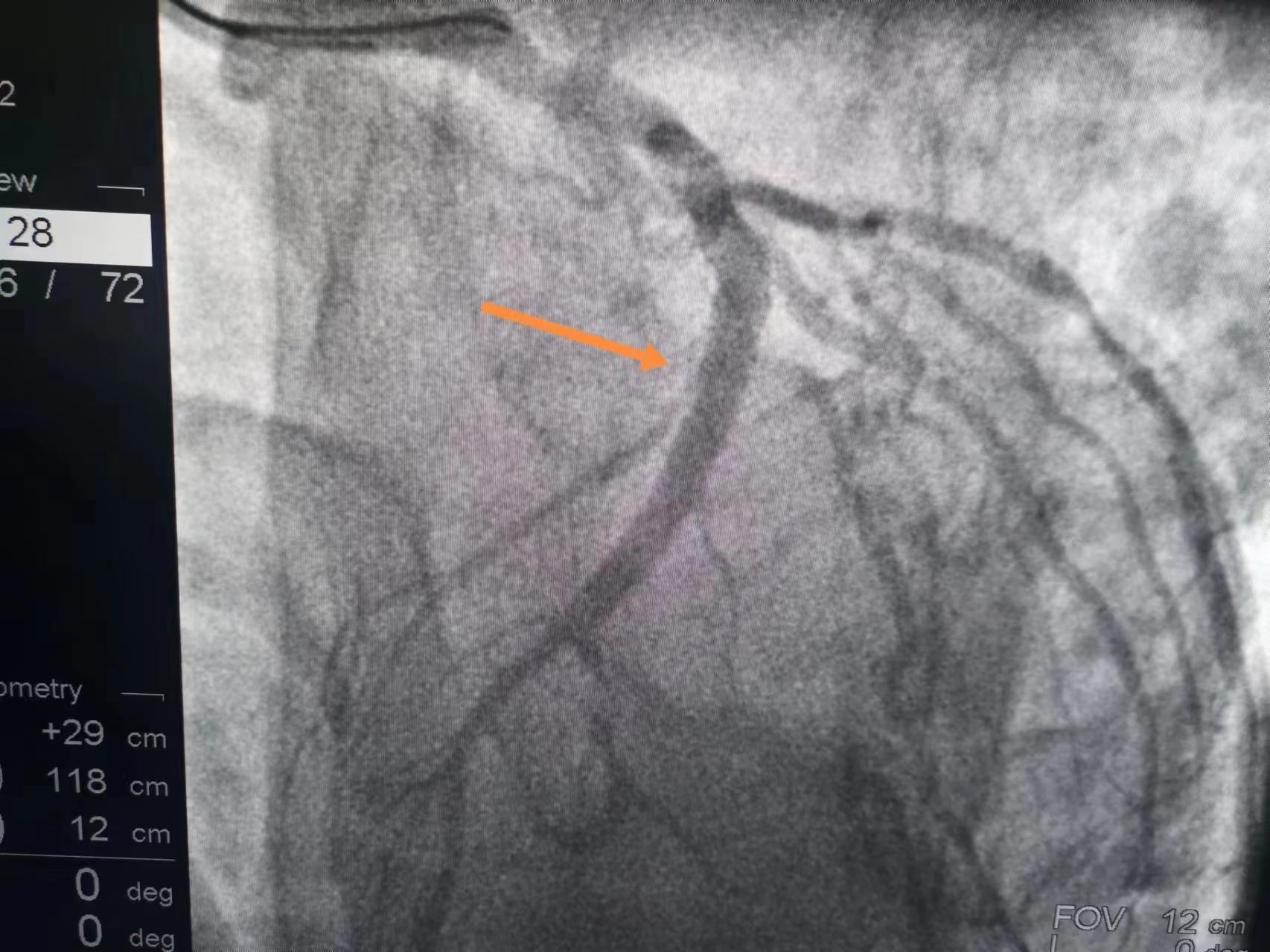 80岁老人得心梗无法手术无法溶栓,42岁突发心梗已下支架