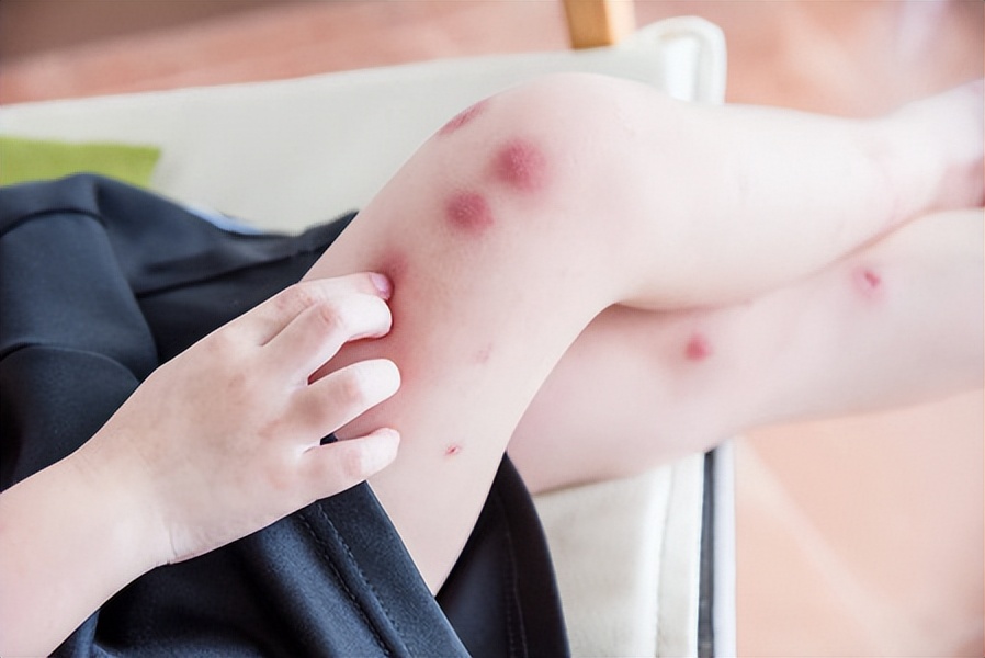 被蚊子咬快速止痒小妙招,蚊子咬的痒吃什么药止痒