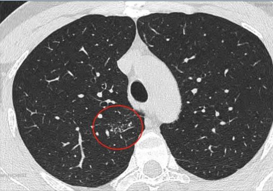 磨玻璃结节9*8mm建议随访,8mm磨玻璃结节一年没长