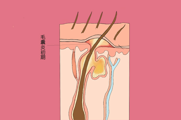 头皮痒一抓就起疙瘩怎么回事,头皮痒一抓就有血丝怎么回事