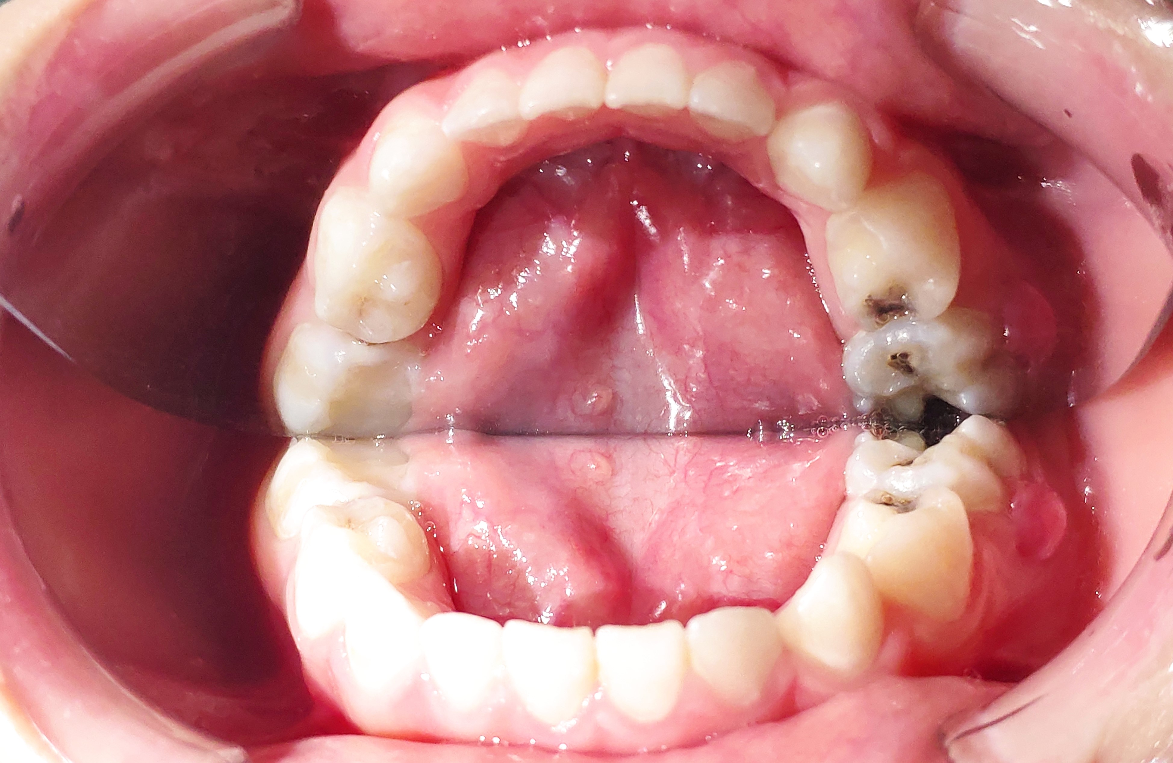 4岁女童竟有10颗蛀牙，协和金银湖院区“舒适医疗”打消嗜甜儿就医恐惧