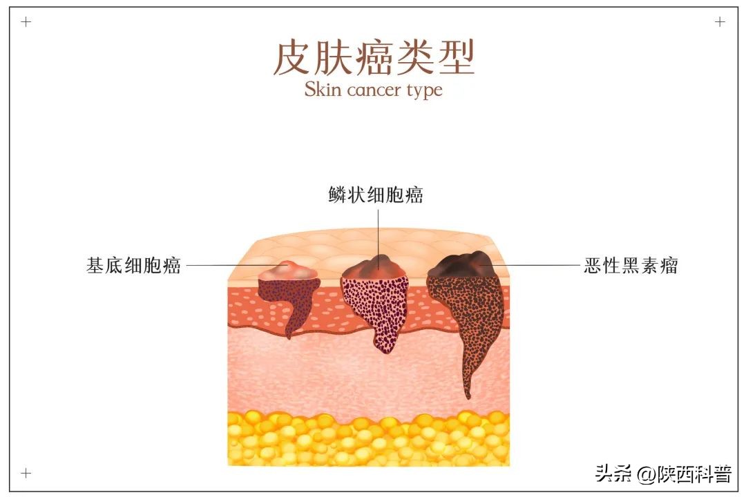 鼻子上的黑头的正确处理方法,鼻子上的黑头大家都是怎么解决的