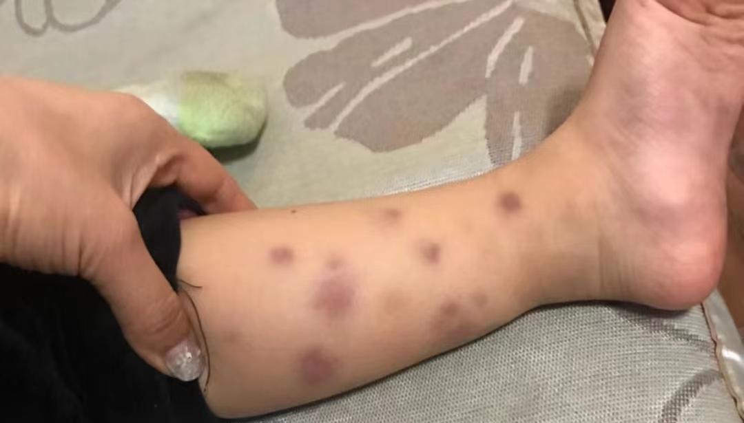 皮疹能完全治愈吗,皮疹可以治愈或者根治吗