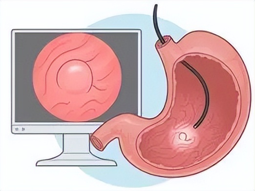 我亲身经历的胃肠镜检查及治疗,做了无痛胃肠镜应注意什么