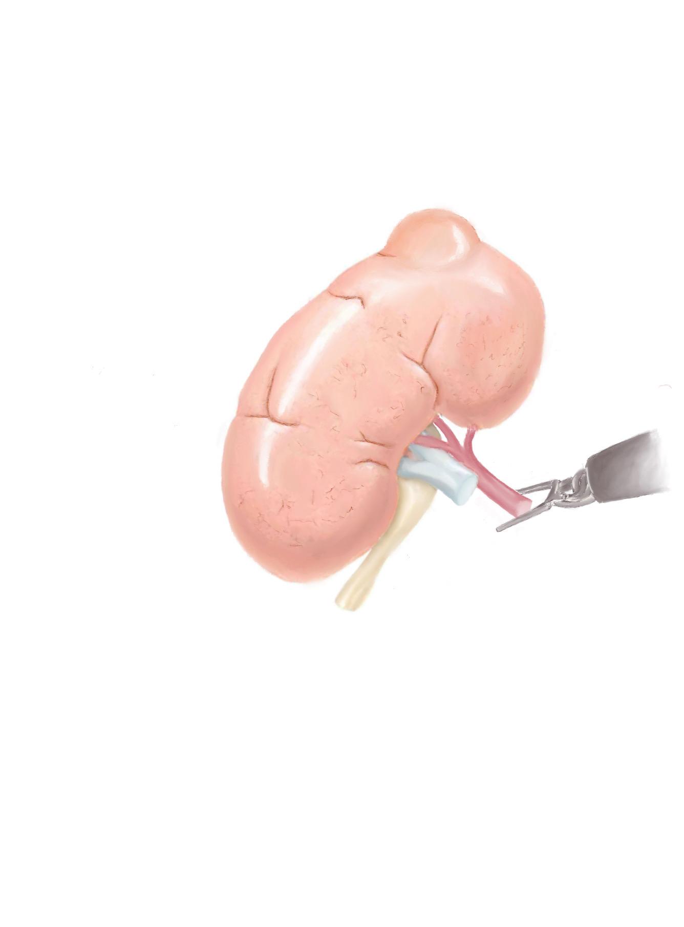 腹腔镜肾切除示意图,腹腔镜肾脏部分切除术