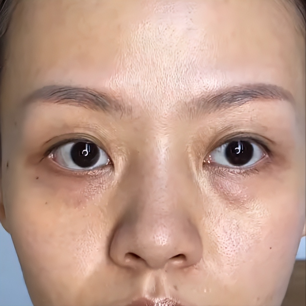 泪沟是凹陷还是下垂,泪沟是什么型的眼袋