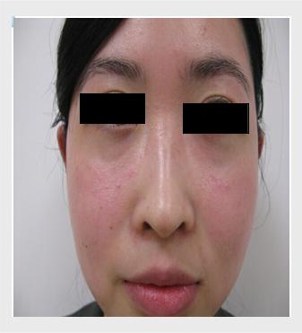 皮肤病玫瑰疹是皮炎吗,皮肤病玫瑰痤疮是怎么引起的