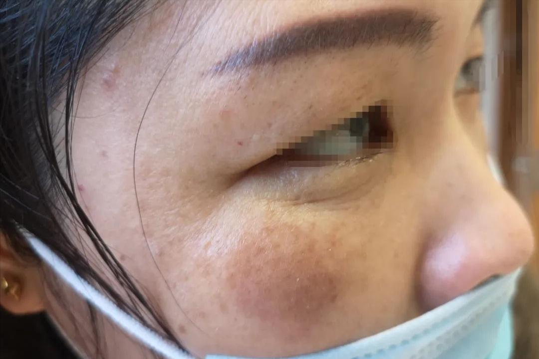 炎症后皮肤黑黑的,怎么办?