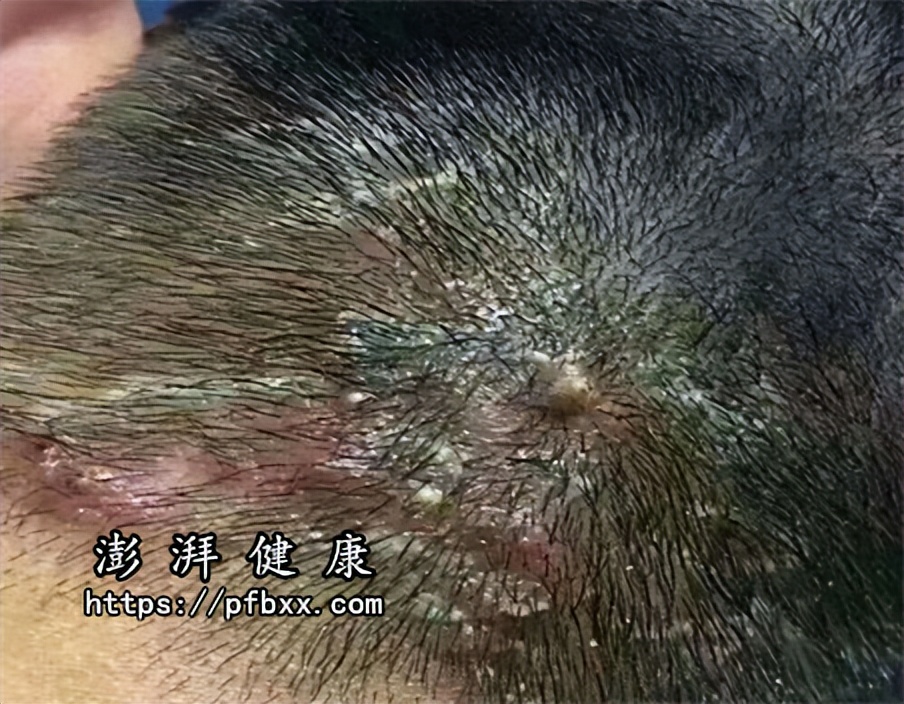 额头脸颊脖子背部长痘痘,额头上长痘痘挤了肿起来了