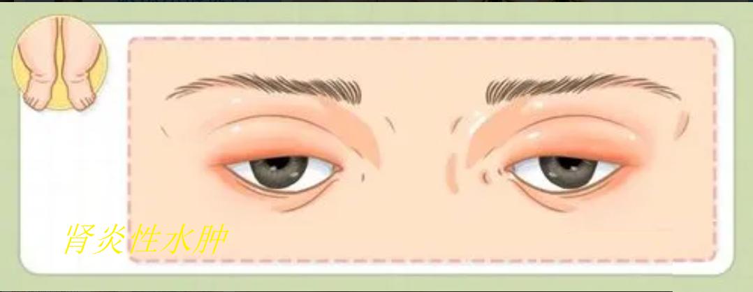 小孩子得了肾炎的症状,孩子肾炎的三大早期症状