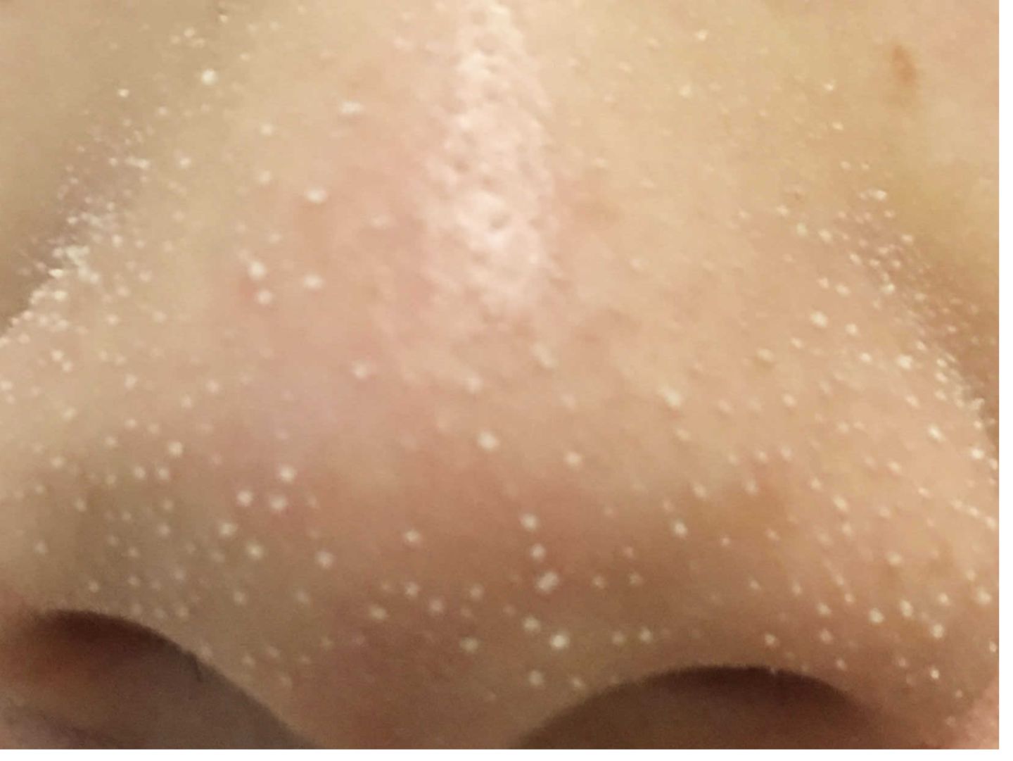 涂完粉底液鼻子上有白点,上完粉底液之后为什么鼻子有白点