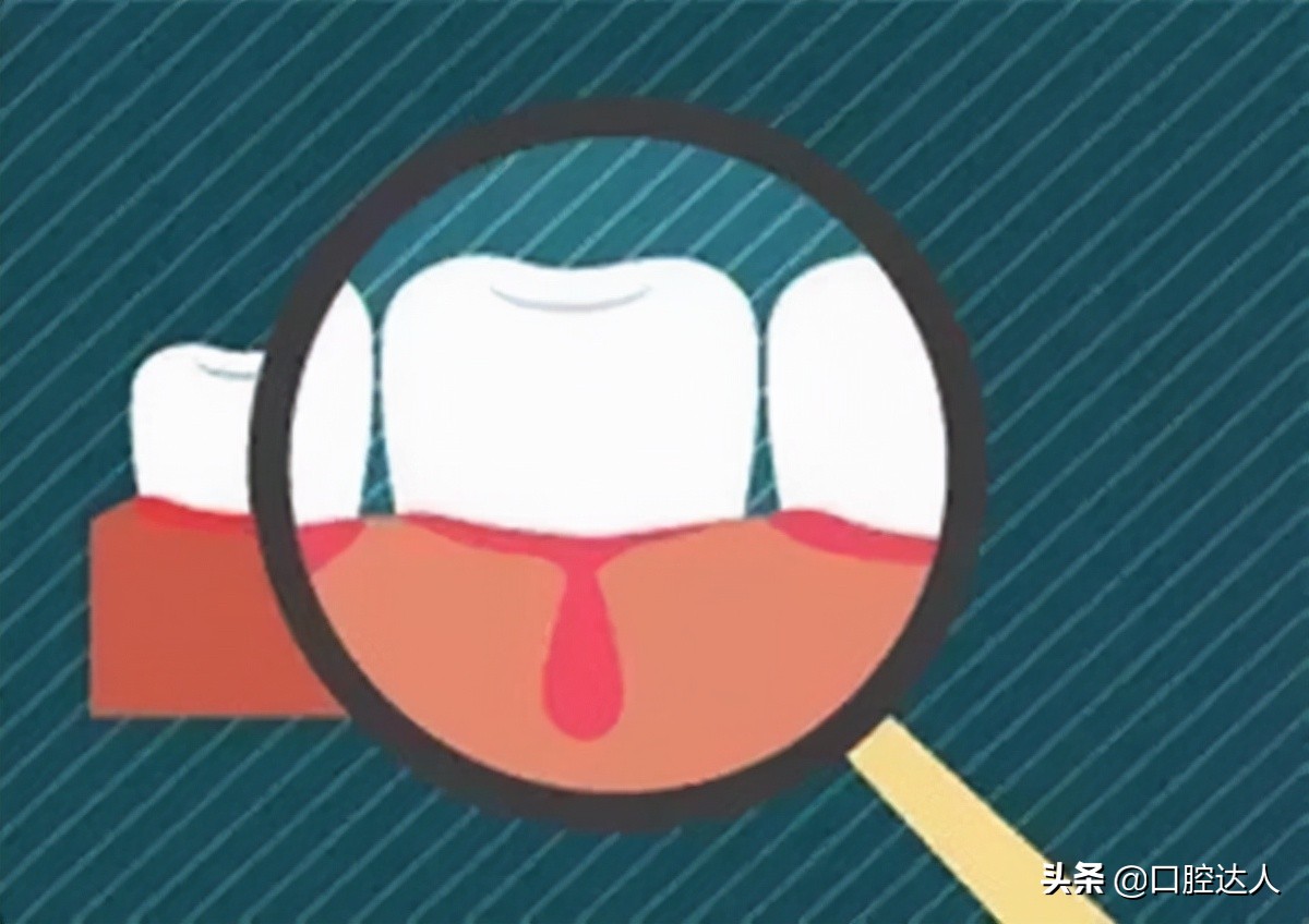 用力一吸牙龈就出血唾液特别臭,用力一吸牙龈就出血是怎么回事