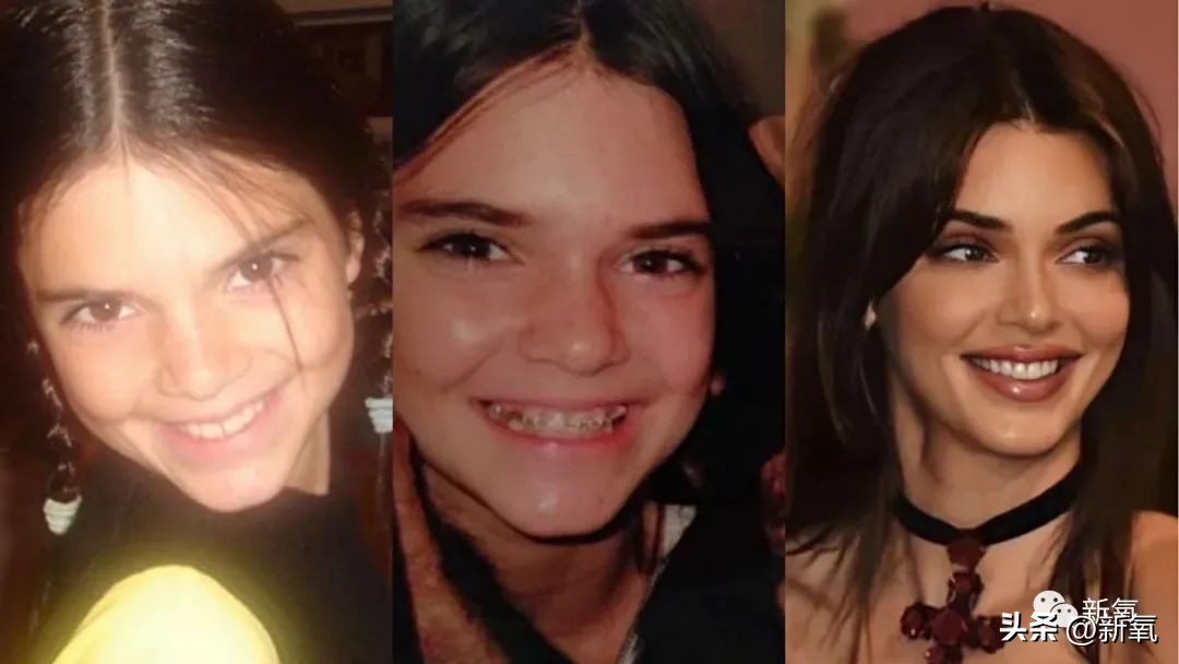 牙齿正畸和骨骼正畸的区别,牙齿正畸和眼轴增长有关系吗