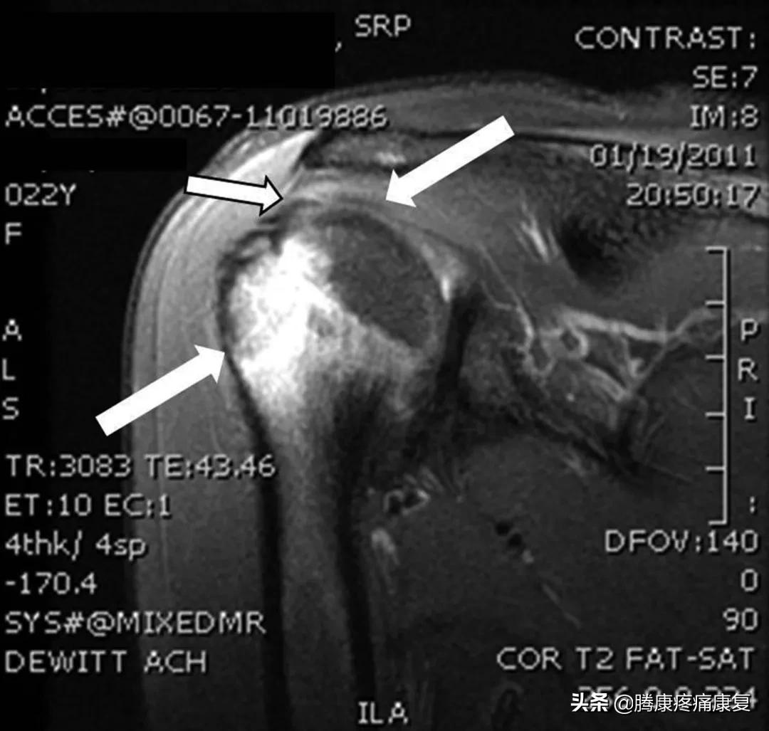 注射疫苗后的肩部疼痛