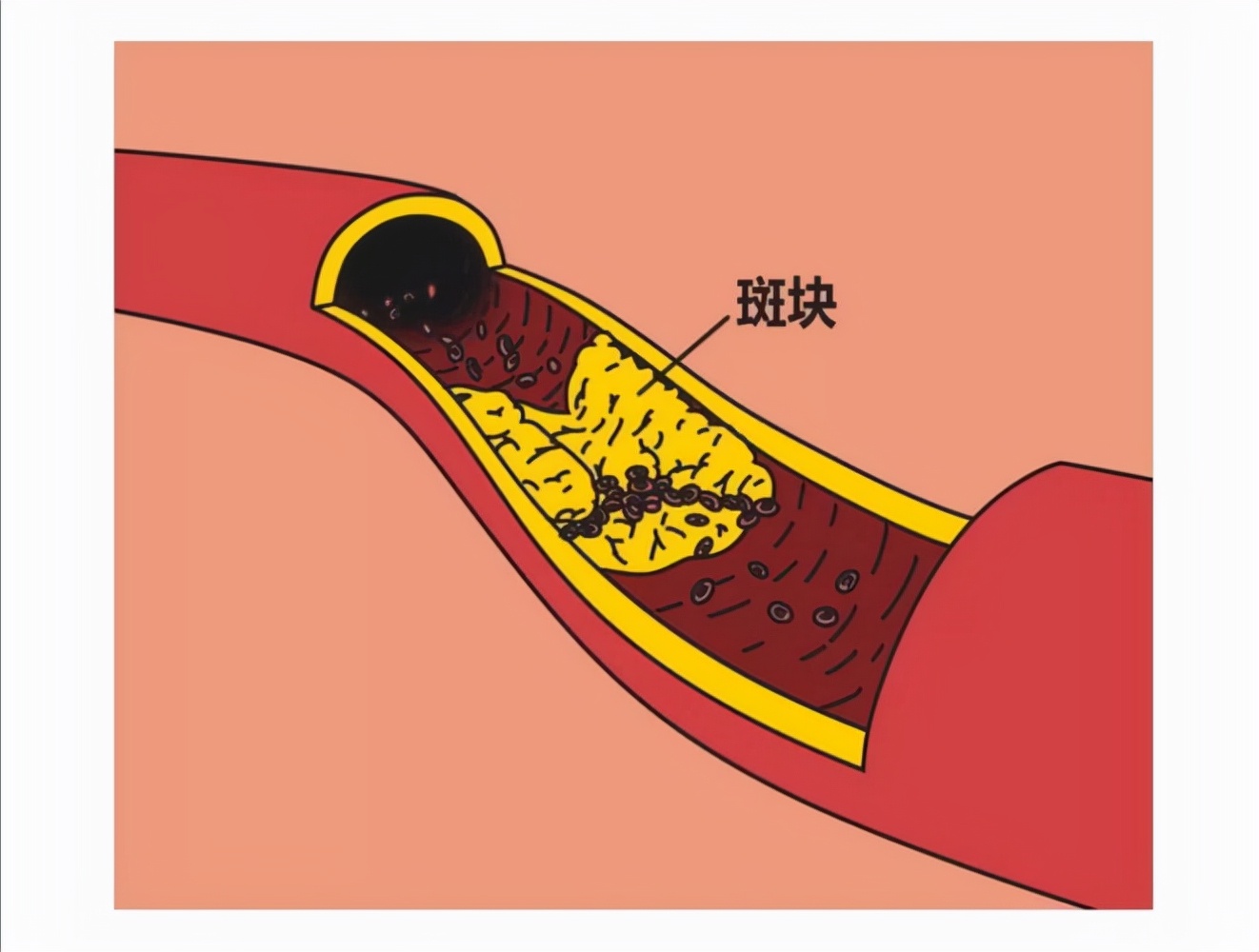 年轻人脑梗死是什么原因造成的,脑梗死是高压还是喝酒导致的