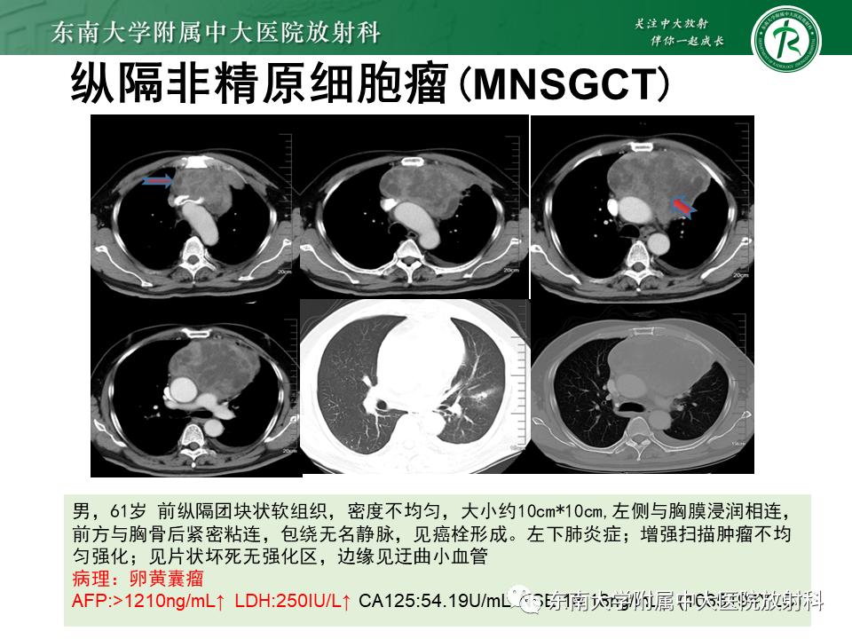 好文分享值得深思,纵隔精原细胞瘤