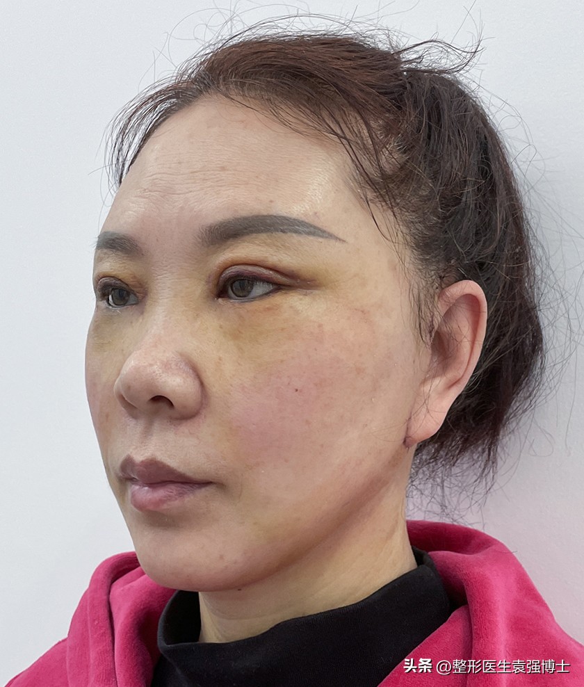 拉皮手术后7天效果图,拉皮手术术后恢复注意事项