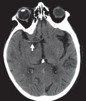 脑水肿的影像,脑水肿形成机制生理学