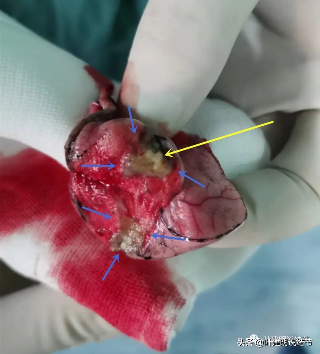 子宫内膜癌术后病灶大于二厘米,子宫内膜癌手术后一年又发现肺癌