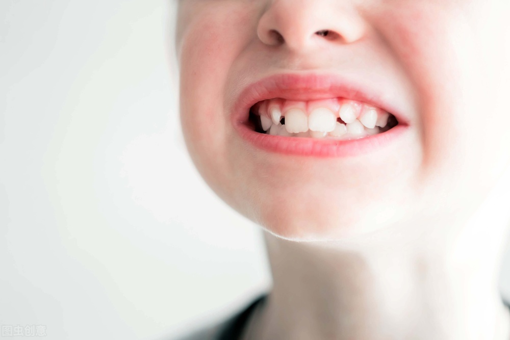 牙齿与牙齿之间空隙大怎么办,牙齿与牙齿之间有空隙