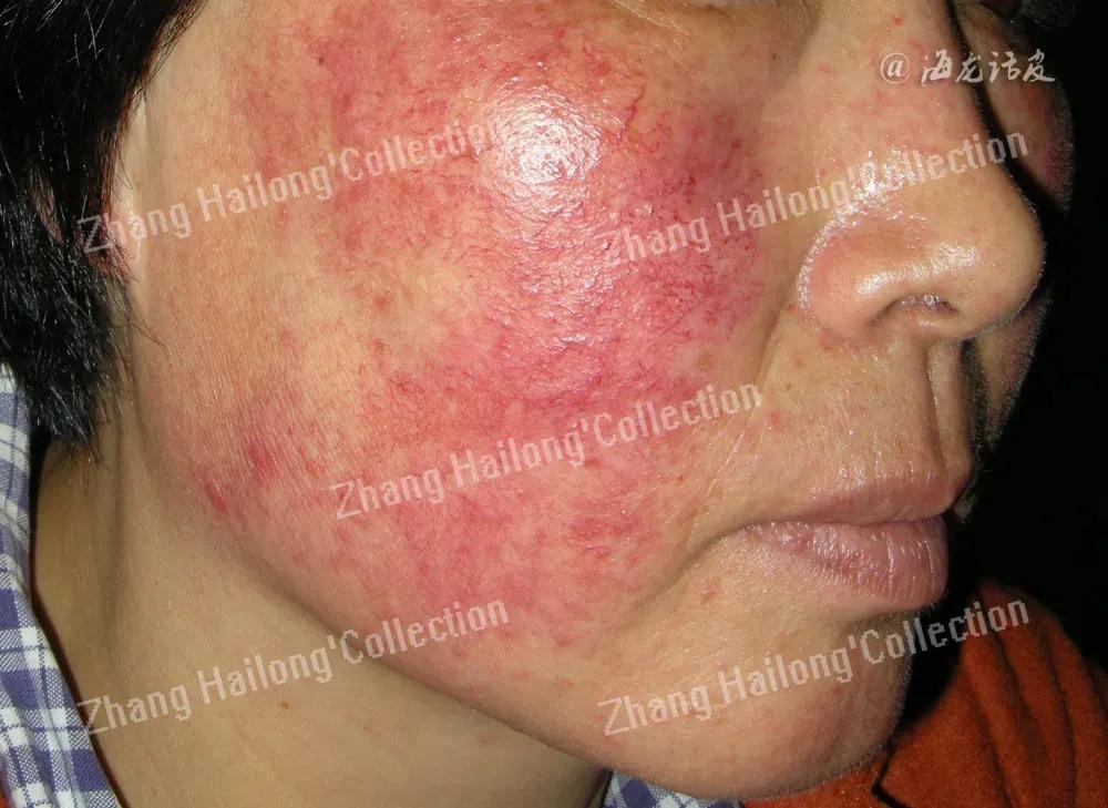 大红脸敏感皮肤,敏感肌肤大红脸怎么办