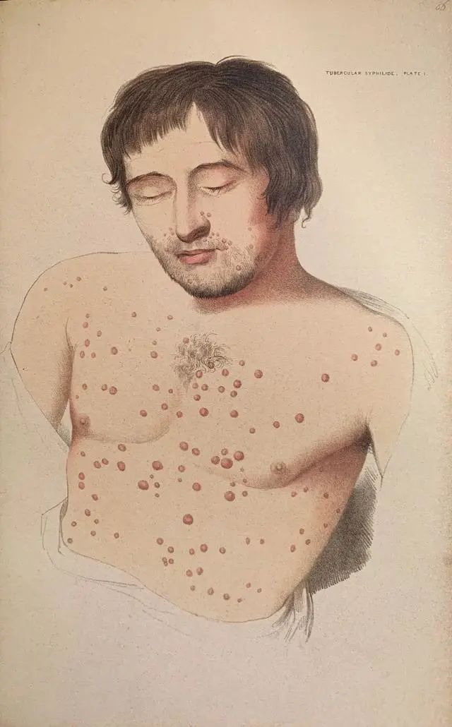 女博士疑因洁牙染梅毒怎么处理,女博士去牙科诊所感染梅毒