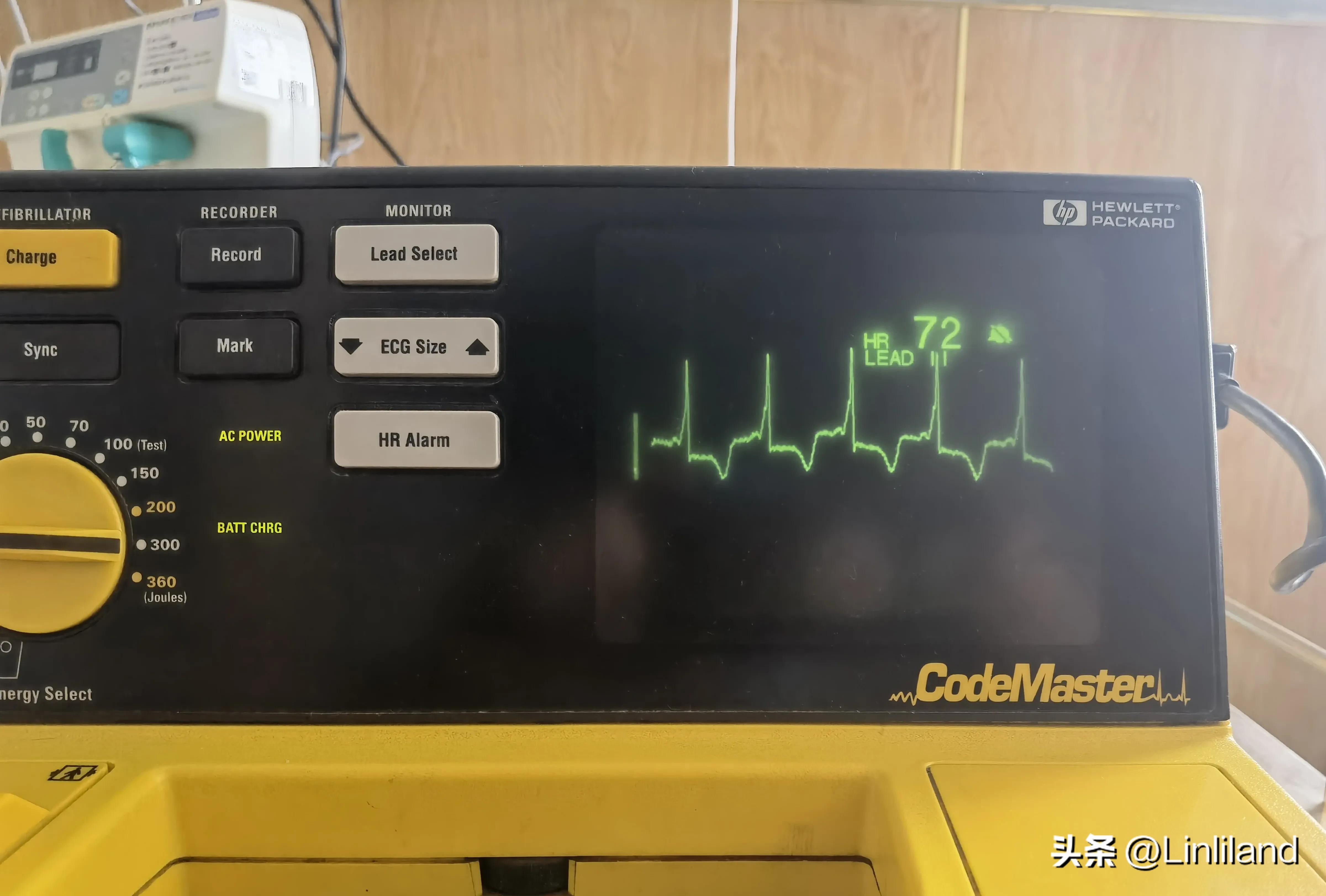 过速性房颤治疗,持续性房颤心动过速