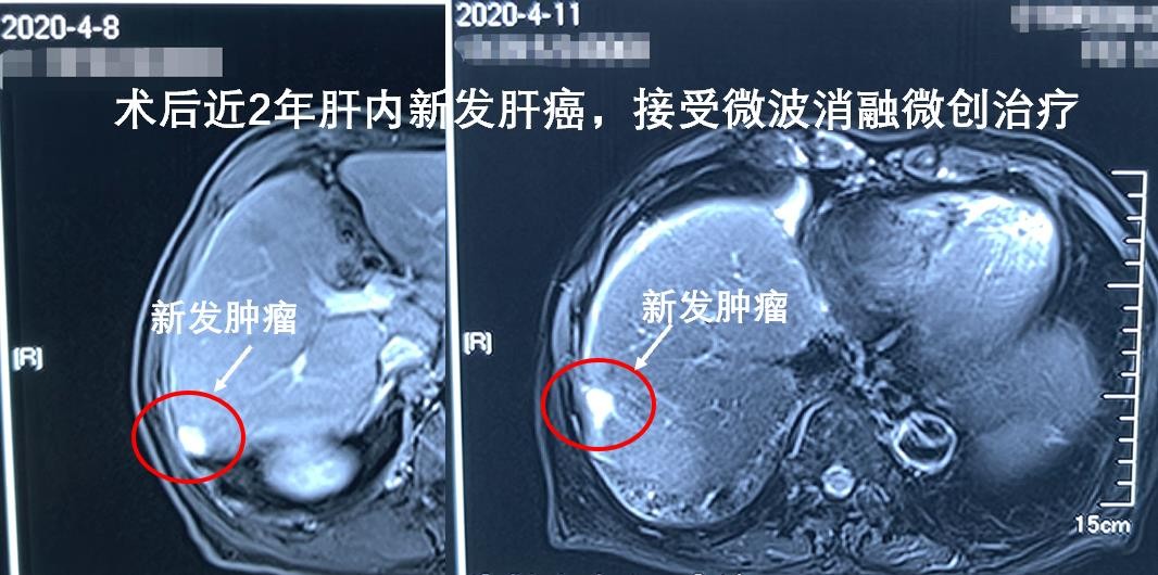 晚期肝癌如何轻松无瘤生活5年？微波消融助力完全“烧死”肿瘤