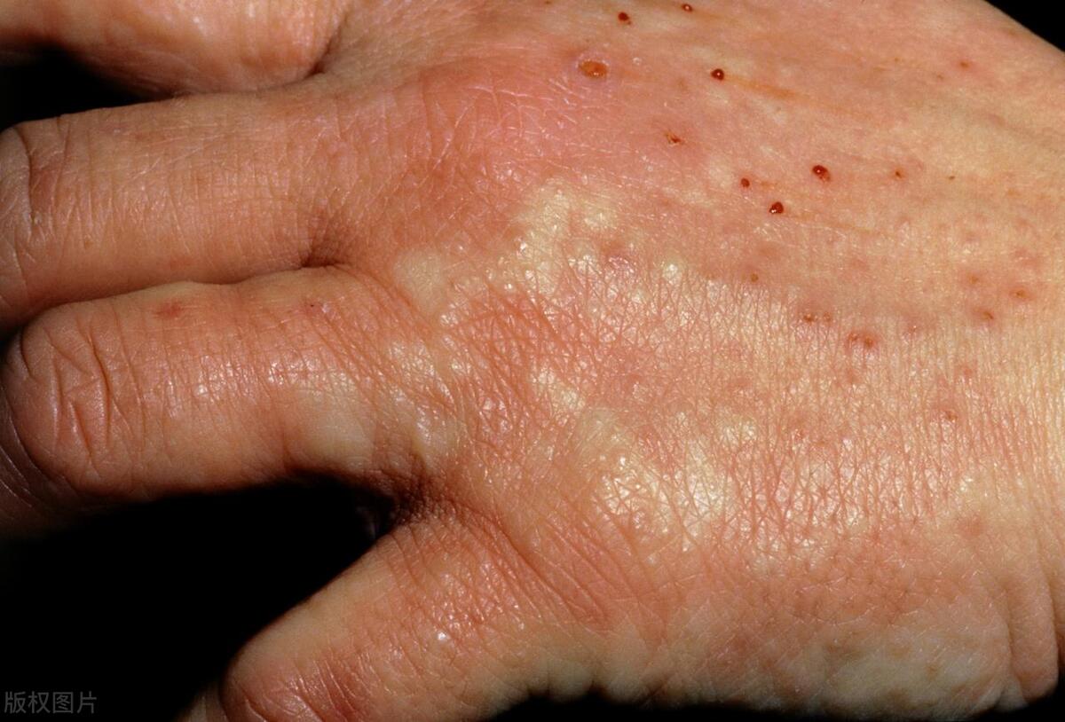 湿气重肥胖皮肤湿疹吃什么药,湿气太重长湿疹怎么祛湿气