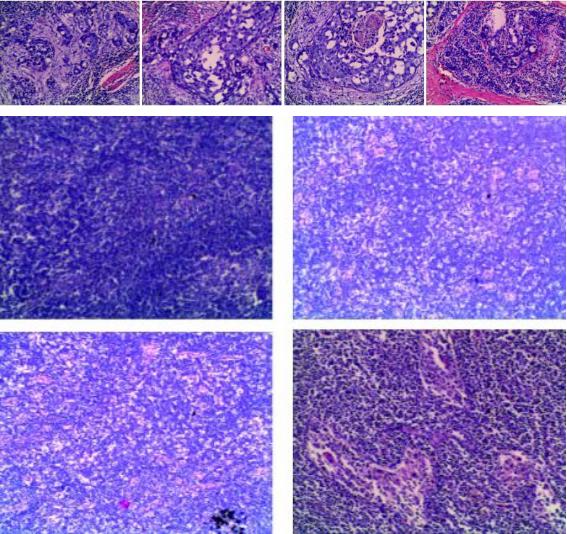抗her2阳性治疗,双靶向治疗her2复发率