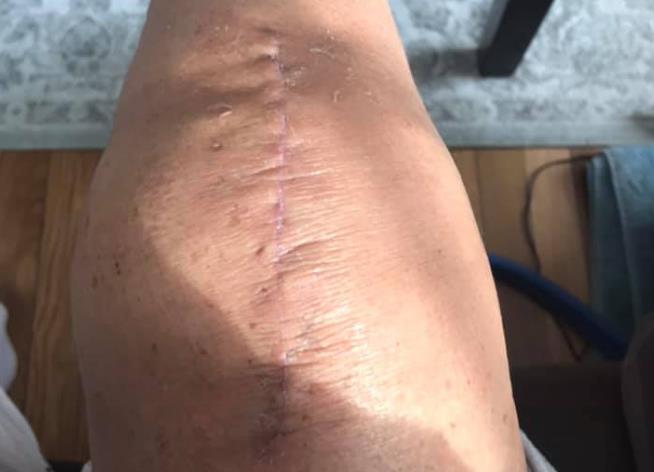 膝盖受伤后多久可以恢复,膝盖手术后伤口多久能愈合