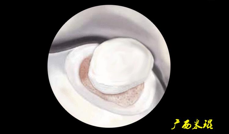 距骨软骨损伤最好的治疗方法,距骨软骨损伤的诊断