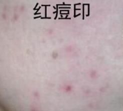 痘痘的10个秘密,痘痘告诉你身体的秘密