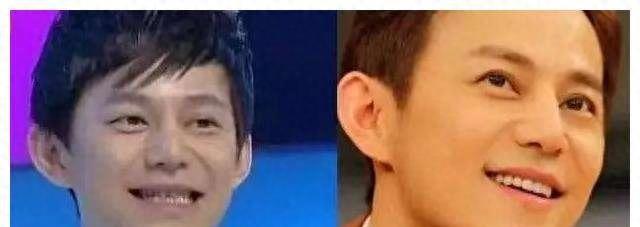 明星烤瓷牙发黑,明星烤瓷牙牙齿磨小后照片