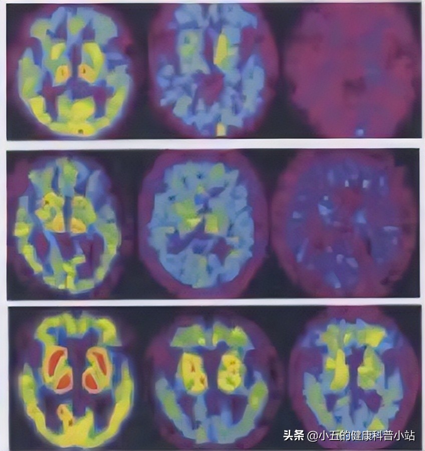 老年痴呆没记忆吃什么药好,老年痴呆症如何改善记忆力