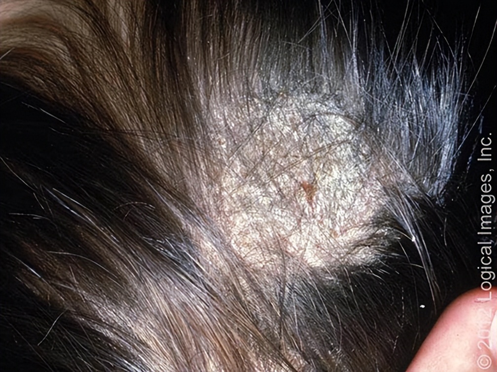 一抓头皮指甲里就有白泥怎么办,头皮一抓指甲里都是白泥