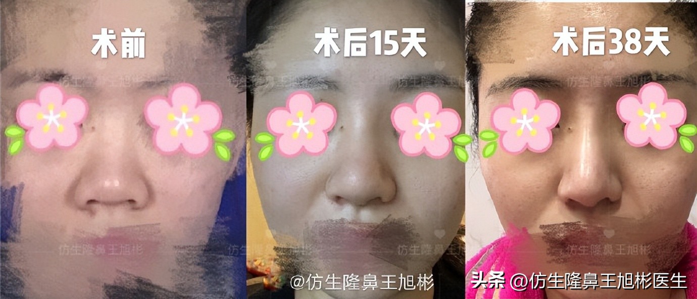 肋软骨的缺点与好处,科普什么是肋软骨鼻综合