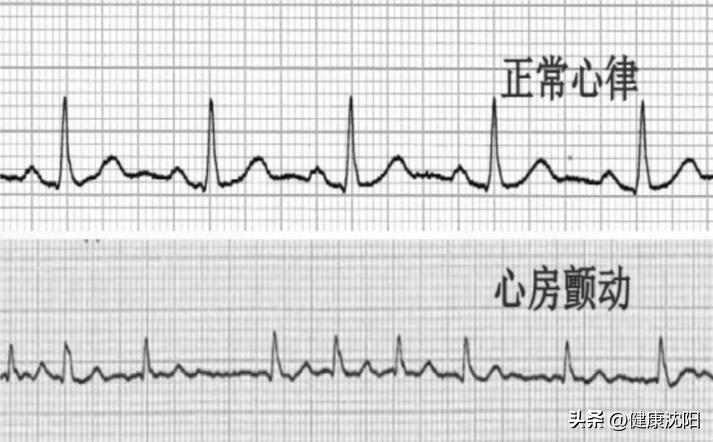 中国房颤最新治疗方案,中国房颤