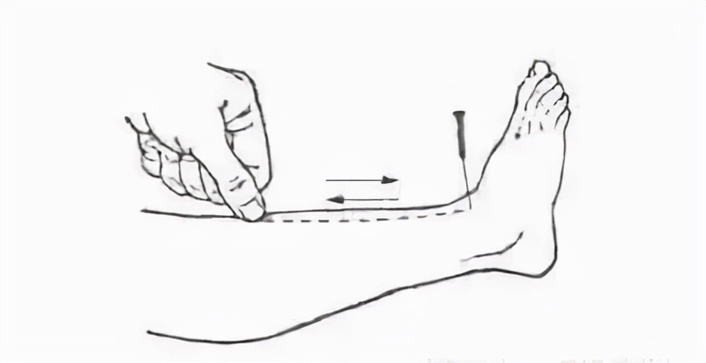 针灸理疗与针灸治疗,针灸原则及治疗方法是上病下治