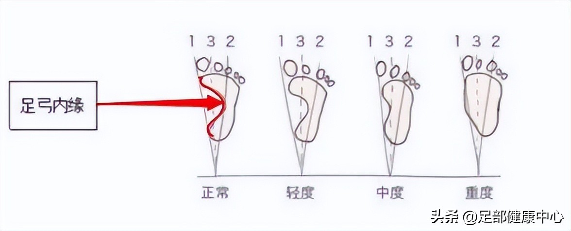 怎么判断扁平足严重程度,如何判断扁平足