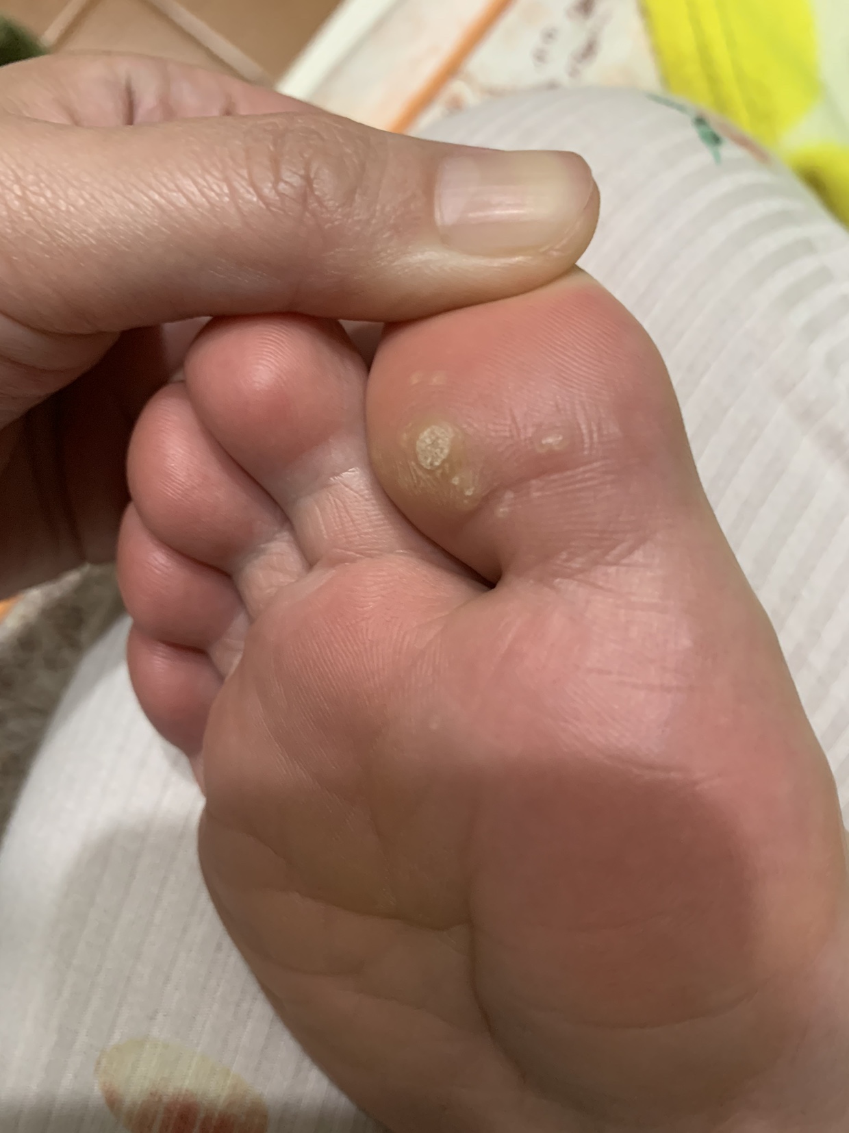 怎样辨别鸡眼和跖疣,如何辨别鸡眼和跖疣区别