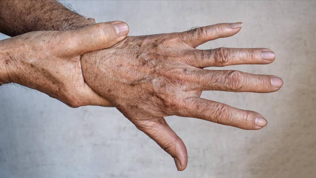 为什么人老会有老年斑怎么消除,为什么会有老年斑怎么去掉