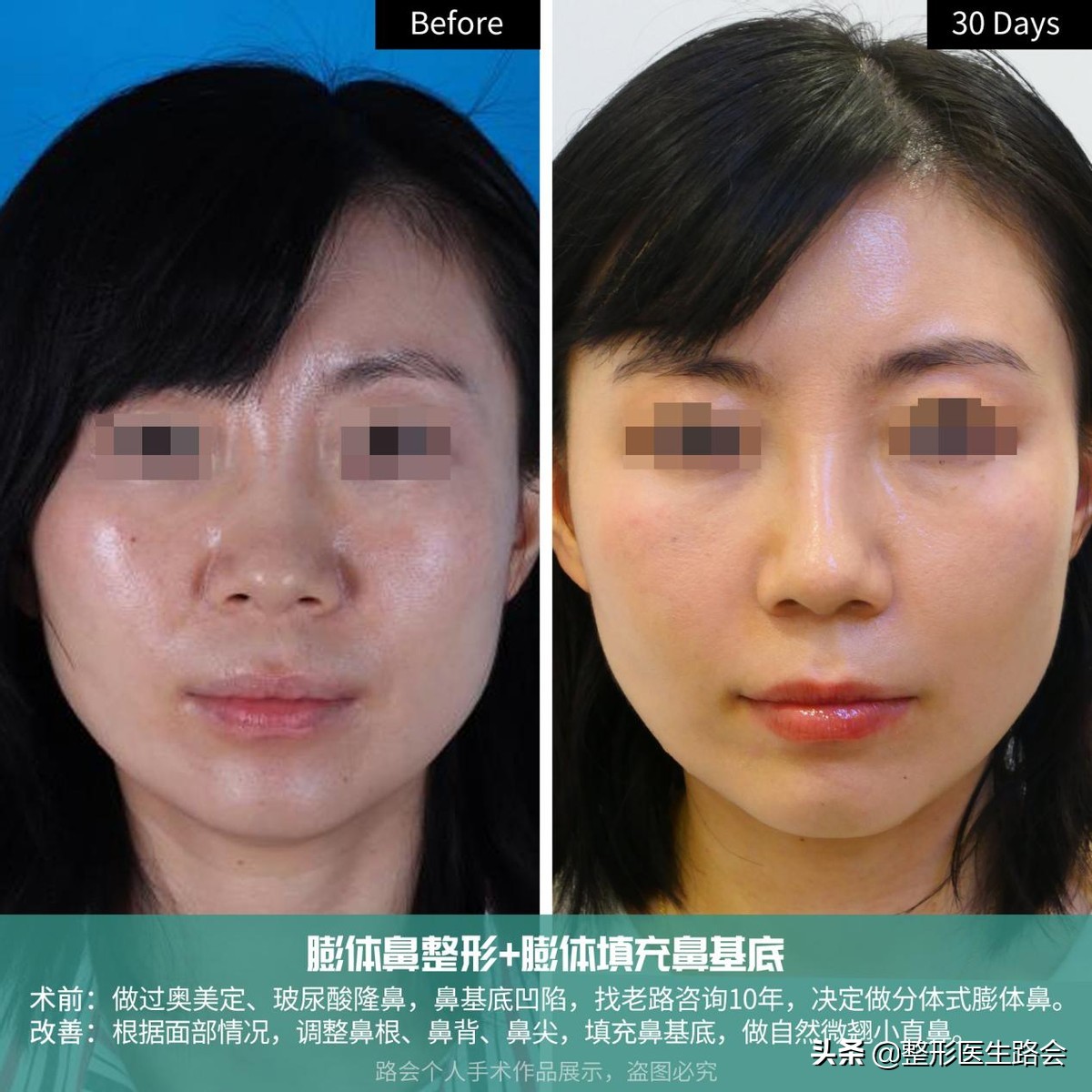 鼻基底填充法令纹瞬间消失,鼻基底填充后法令纹能改善多少