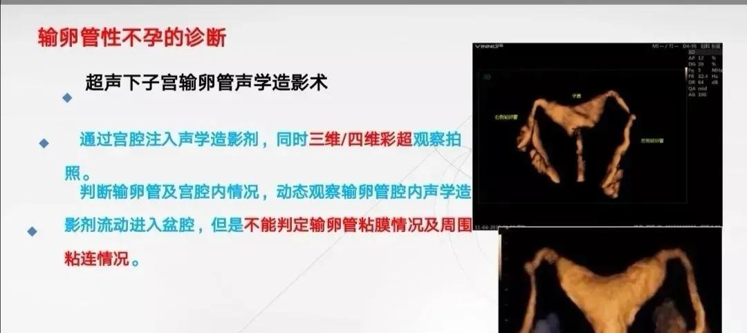 比输卵管造影好的输卵管检查,输卵管检查需要多少费用