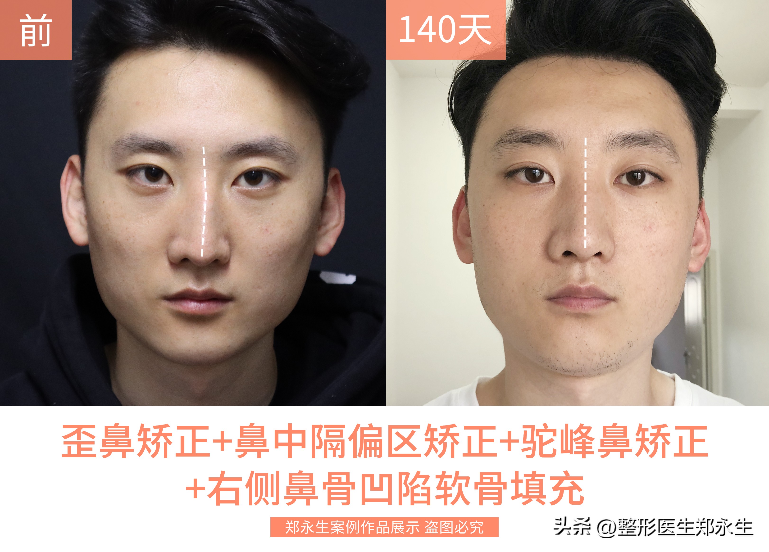 歪鼻是什么原因引起的,歪鼻歪鼻