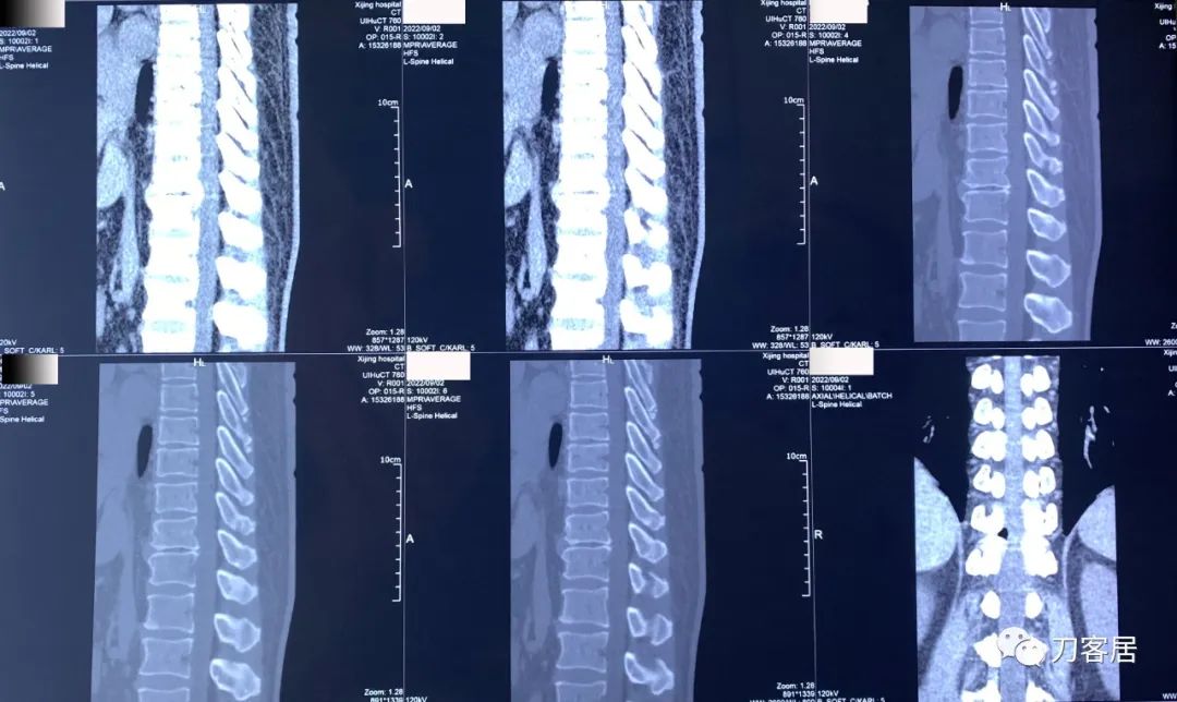 良性单侧下肢肌萎缩,下肢肌肉萎缩24年能治好吗