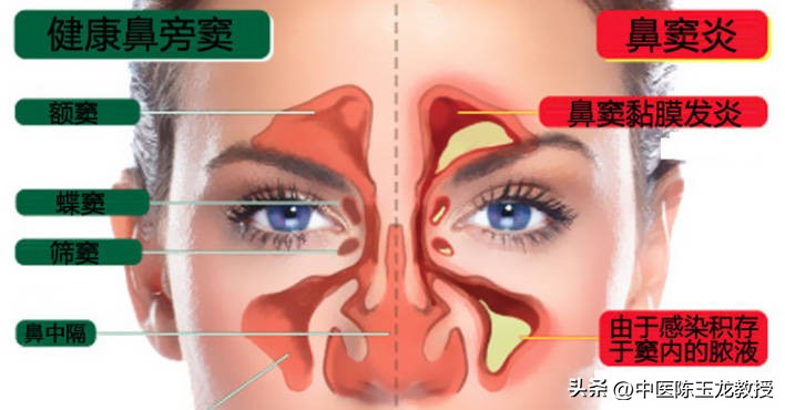 头微痛鼻塞吃什么药,急性鼻窦炎鼻塞怎么缓解