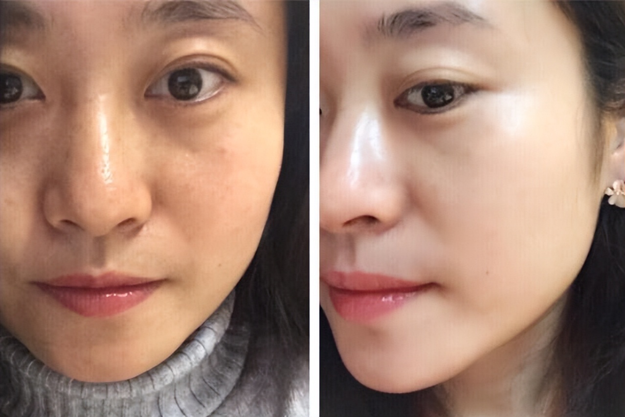 泰国女子打6年美白针六胜肽,女子打美白针后身患多病