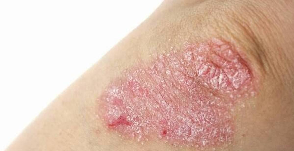 银屑病中医辨证论治根源,中药外用治银屑病研究进展